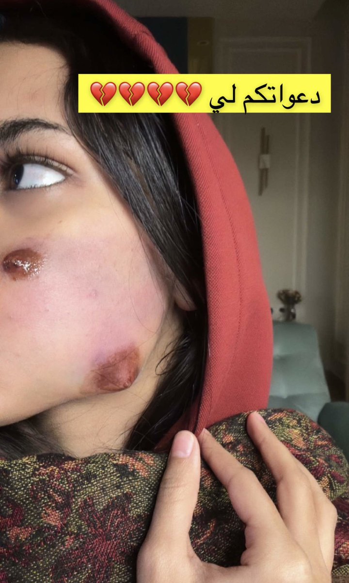 gorgeous4ew's tweet photo. غناتي القحطاني توثق تعرضها لطفح جلدي تسبب في انتفاخ جزء من وجهها 😰💔 https://t.co/BckUETSjEE