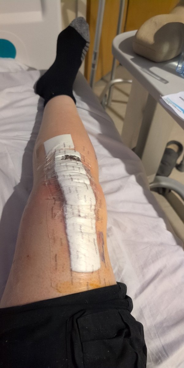 Terry_H's tweet photo. Sitting in my hospital bed after knee replacement. Waiting for the last leg, feeling like for once. I actually have something in common with people on the TV,  - I'm a twat. 
#TheLastLeg #adamhills https://t.co/tIRmoHymOi