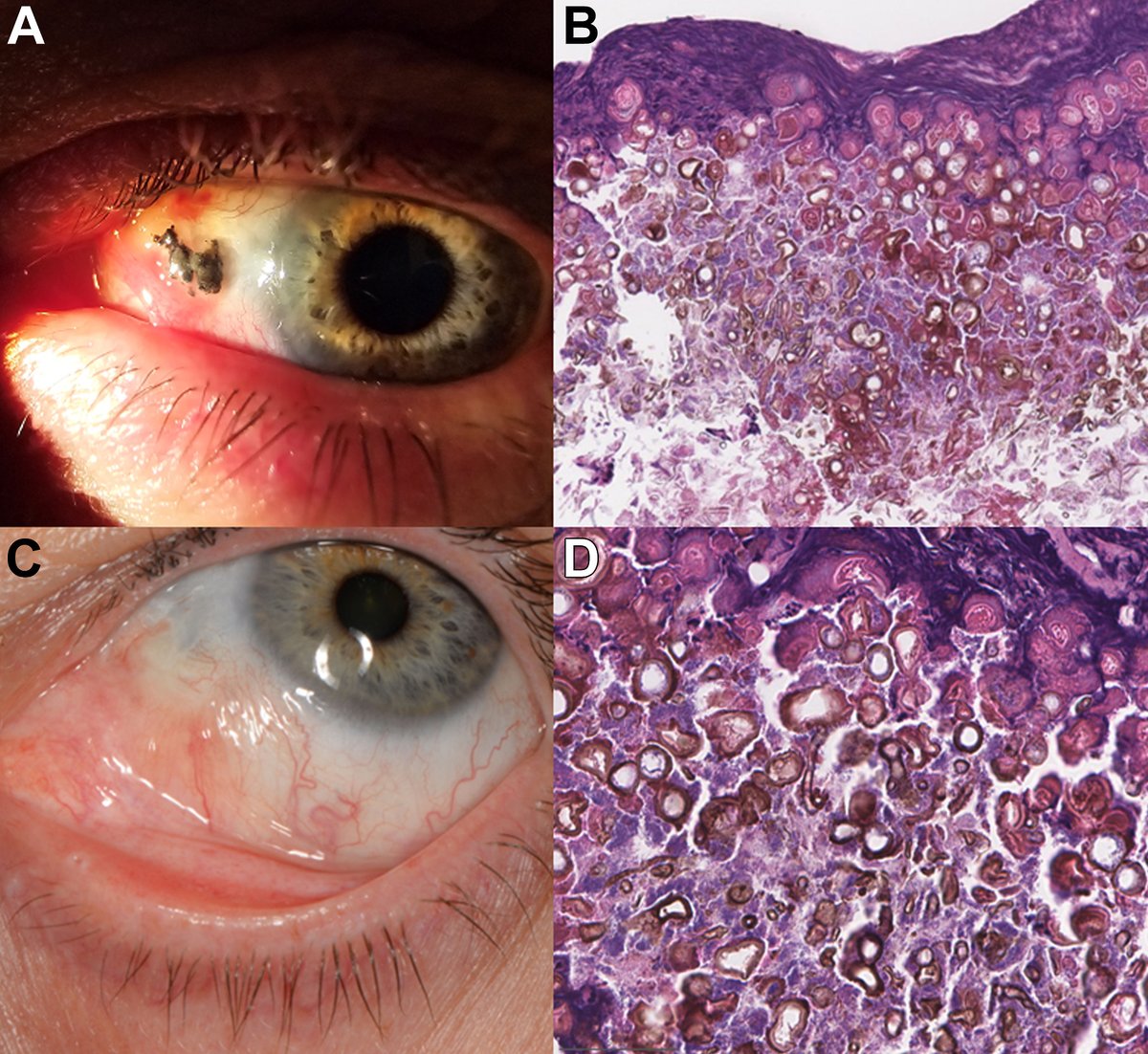 aao_ophth's tweet photo. A woman in her 50s with history of pterygium status postexcision presented with slow-growing black pigmented conjunctival lesion. The patient initially noted pain in the pterygium area. Four months later, enlarging black pigmentation was noted. A conjunctival lesion was surgically excised, and pathology revealed foreign material (glue and amniotic membrane graft) with septate fungal forms, adjacent to inflamed, eroded conjunctiva. Histopathologic examination was consistent with phaeohyphomycosis. Fascinating case of phaeohyphomycosis, a pigment-producing fungus, mimicking melanoma. 

The patient was healing well 40 days postoperatively after voriconazole drops.  From “Phaeohyphomycosis, a Pigment-Producing Fungus, Mimicked Melanoma on External Examinations” by Crystal W. Law, PA-C, William H. Constad, MD, Jasmine H. Francis, MD. Published by Ophthalmology online on December 21, 2024.  

 #ophthamology #aaojournal #eyesurgeon #surgery #medical #medicine #surgeon #eye #ophthalmologist 

https://t.co/t8lwFMP4p5