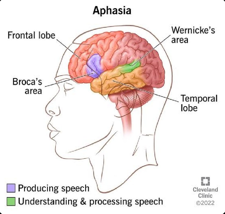Did You Know that
Aphasia is a language disorder caused by damage to parts of  the brain that control speech and understanding of language,Aphasia affects a person's ability to express and understand written and spoken language.