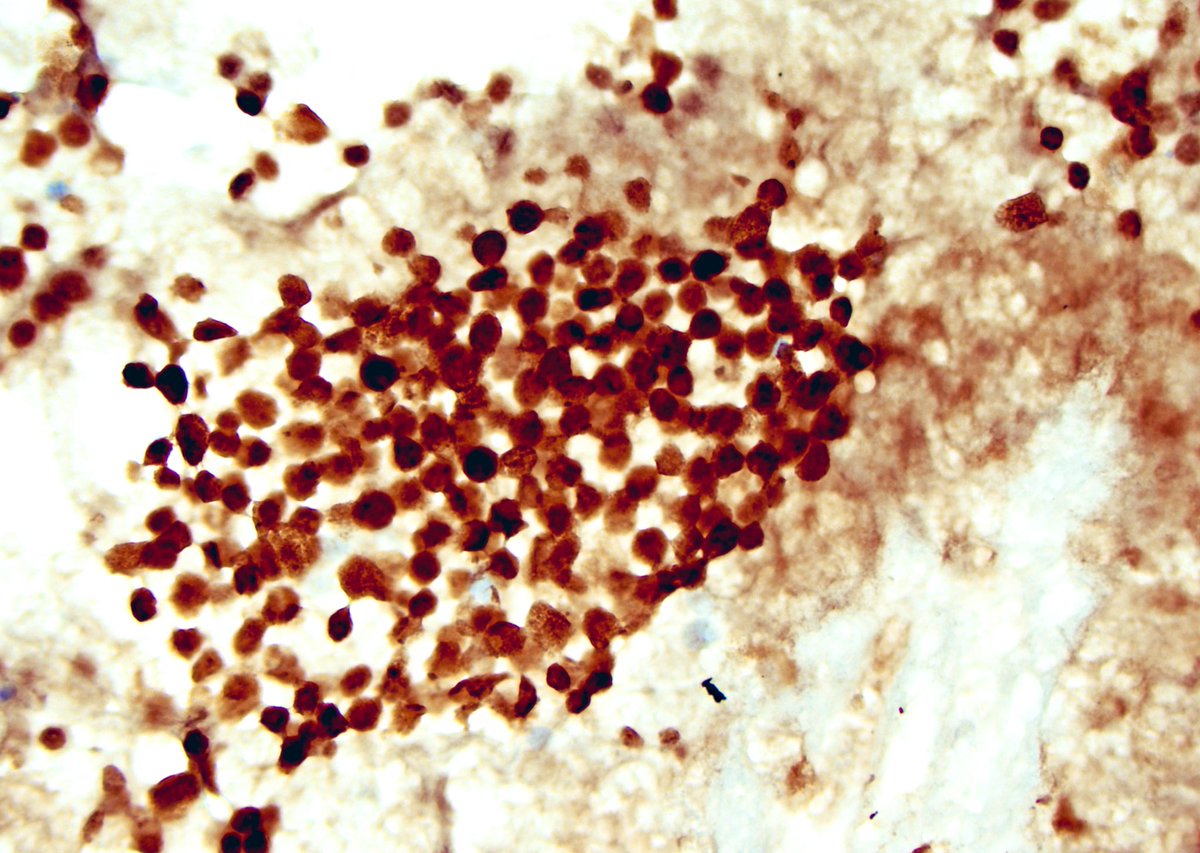 Zahra Maleki, MD, MIAC (@zmaleki_cyto) on Twitter photo IHC and GPS seem parallel to me. It is hard to imagine life without them. They both help to take us to our destination however, we should know where the destination is.  PHOX2B highlights metastatic neuroblastoma in bone of a kid.  #CytoPro  <a href="/IACytology/">International Academy Cytology</a> <a href="/ESP_Pathology/">European Society of Pathology (ESP)</a> #cytology IHC and GPS seem parallel to me. It is hard to imagine life without them. They both help to take us to our destination however, we should know where the destination is.  PHOX2B highlights metastatic neuroblastoma in bone of a kid.  #CytoPro  <a href="/IACytology/">International Academy Cytology</a> <a href="/ESP_Pathology/">European Society of Pathology (ESP)</a> #cytology