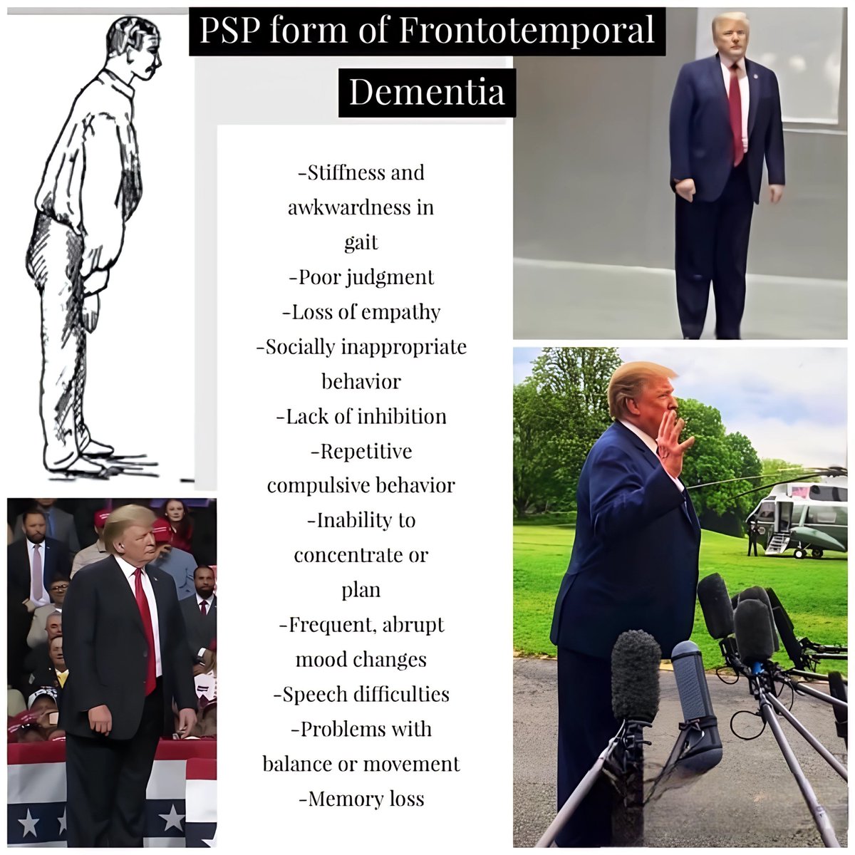 mlauzon's tweet photo. @MeidasTouch That #forward #lean is an #indicator that Trump has #PROGRESSIVE #SUPRANUCLEAR #PALSY (#ProgressiveSupranuclearPalsy/#PSP) which is a form of #FRONTOTEMPORAL #DEMENTIA (#FrontotemporalDementia/#FTD)...! https://t.co/i4bAzVZlaR
