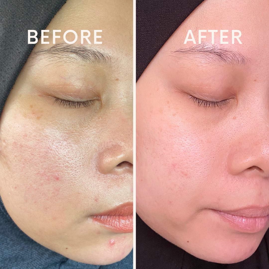 The result of "spray tak ingat dunia" ✨

— skin i memang on off naik redness but once i try #BTEYUNA i perasan cepat je surut redness tu.

Time malas nak buat night routine, spray je BTE ni dah cukup. Esok pagi herlokk je skinnya. 😘