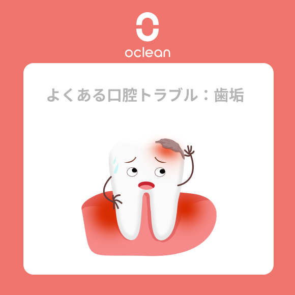 Oclean_JP's tweet photo. 口腔ケアを怠ると、さまざまな口腔トラブルが引き起こされます！😥

今回はよくある口腔の問題とその対策をご紹介します。
皆さまが健康な口腔を維持できるよう、お役に立てれば嬉しいです😬

＜よくある口腔トラブル：歯垢（プラーク）＞
歯垢は歯の表面に付着する細菌の塊で、黄白色の斑点として現れます。
これが原因で、歯が黄ばんで見えることもあります。

歯垢はむし歯、歯周病、口臭を引き起こし、細菌が血流に乗って全身に影響を与えることもあります😟

対策：
❶🪥フッ素入りの歯磨き粉で毎回食後にしっかり歯を磨く；
❷🦷デンタルフロスや口腔洗浄器、抗菌性マウスウォッシュで清潔を保つ；
➌🏥甘いものを控え、定期的に歯科医院で歯のクリーニングを受ける。

#口臭対策 #口腔健康 #口腔ケア ＃オーラルケア ＃歯周病 ＃電動歯ブラシ  #ジェットウォッシャー