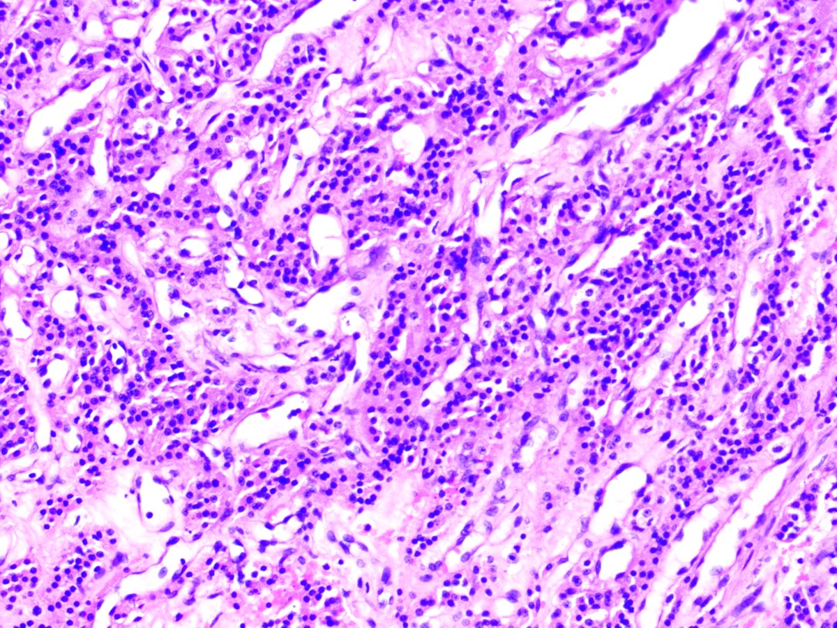 NewjobiRakesh's tweet photo. Endobronchial bx in 50/m #pathology #PathTwitter #pathresidents #pulmopath https://t.co/qpneSkQ94g