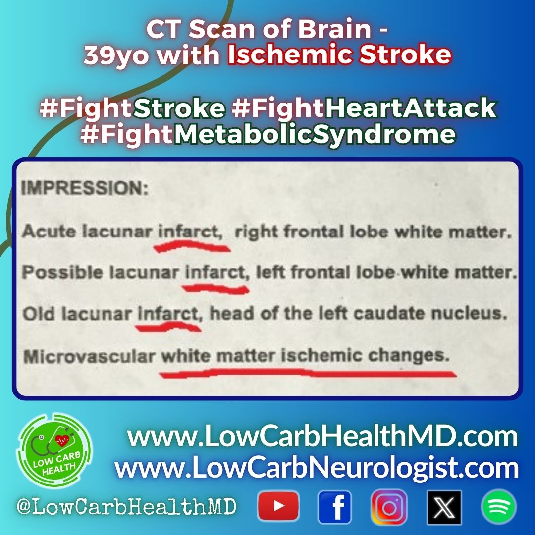 Low Carb Health Doctor | LCHD | Dr. Don Agcopra (@lowcarbhealthmd) on Twitter photo BRAIN SCAN of recent patient - YOUNG, but already had STROKE! My YOUNGEST ADULT STROKE PATIENT: 26 years old. ๐ฌ๐ข๐จ๐ก๐๐๐ฅ ๐ฎ๐ป๐ฑ ๐ฌ๐ข๐จ๐ก๐๐๐ฅ -
๐๐๐๐๐๐๐ ๐๐๐๐๐๐๐๐๐๐/๐๐๐๐๐๐๐๐๐ ๐๐๐๐๐๐๐๐. ๐ฟ๐๐พ๐๐๐๐, ๐๐ผ๐๐ ๐๐!
๐ bit.ly/FightMetabolicโฆ BRAIN SCAN of recent patient - YOUNG, but already had STROKE! My YOUNGEST ADULT STROKE PATIENT: 26 years old. ๐ฌ๐ข๐จ๐ก๐๐๐ฅ ๐ฎ๐ป๐ฑ ๐ฌ๐ข๐จ๐ก๐๐๐ฅ -
๐๐๐๐๐๐๐ ๐๐๐๐๐๐๐๐๐๐/๐๐๐๐๐๐๐๐๐ ๐๐๐๐๐๐๐๐. ๐ฟ๐๐พ๐๐๐๐, ๐๐ผ๐๐ ๐๐!
๐ bit.ly/FightMetabolicโฆ