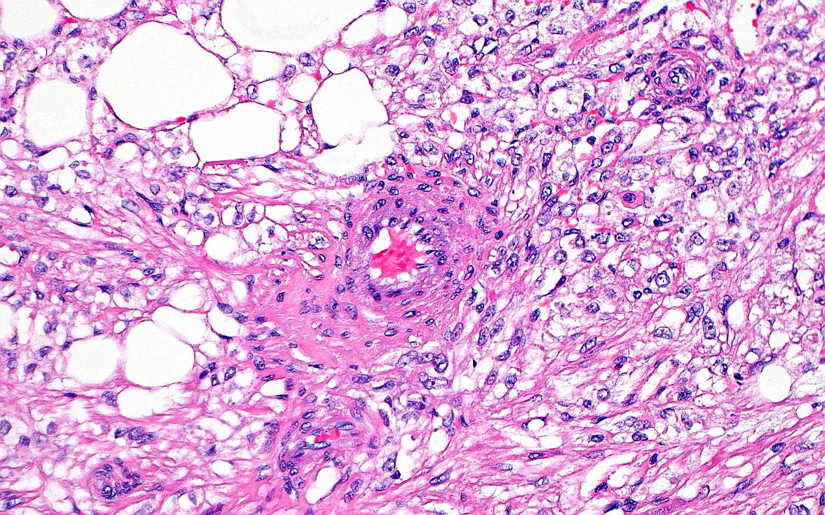 🔬 Angiomyolipoma ~ #GUpath #KidneyTumors #Pathology #Urology
➡️ Blood vessels = "angio"
➡️ Spindle/smooth muscle cells = "myo"
➡️ Fat = "lipo"