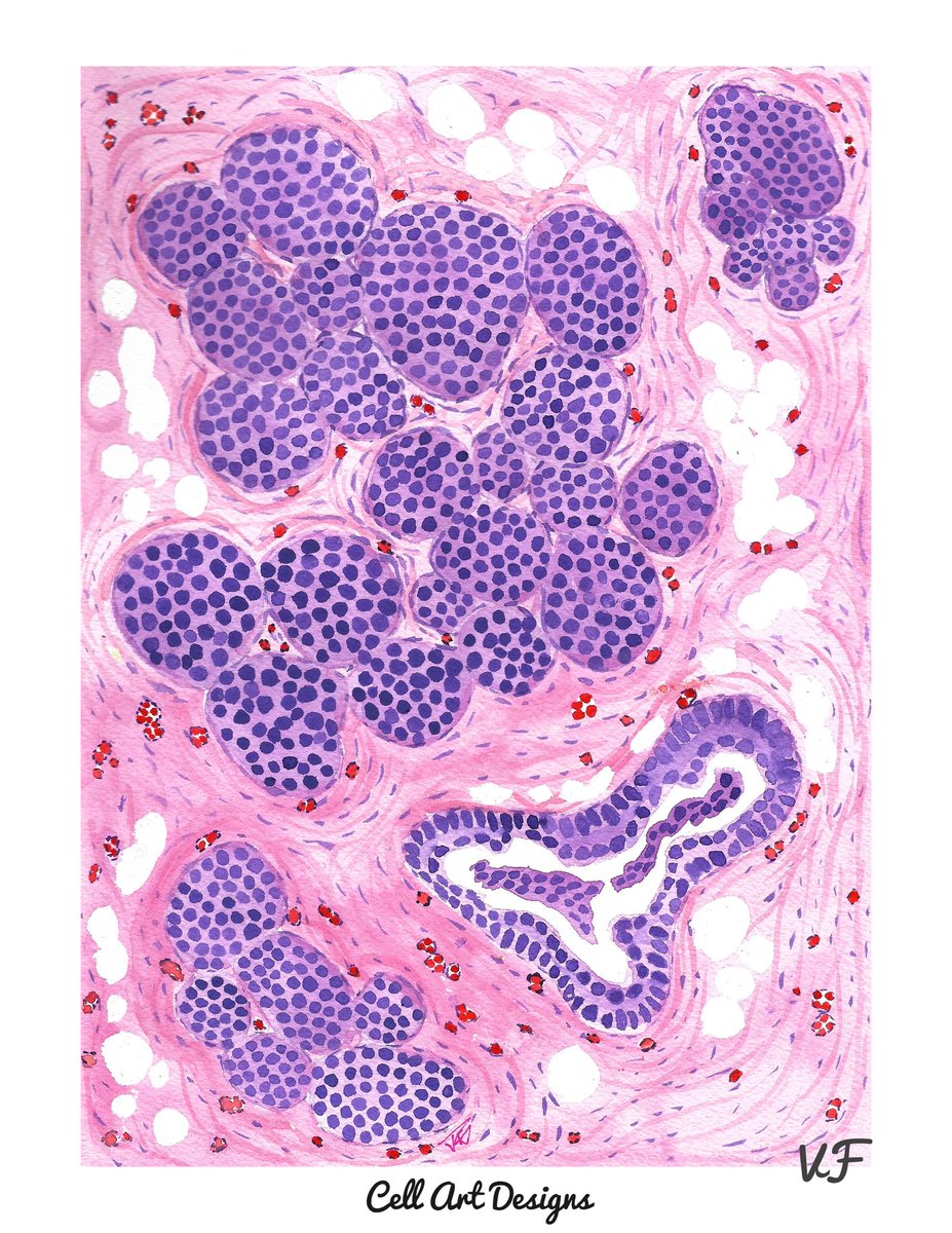 Haven’t picked up a paint brush in a minute but recently got inspired by LCIS so here you go! Done in watercolor. #pathart #breastpath #pathX #pathology