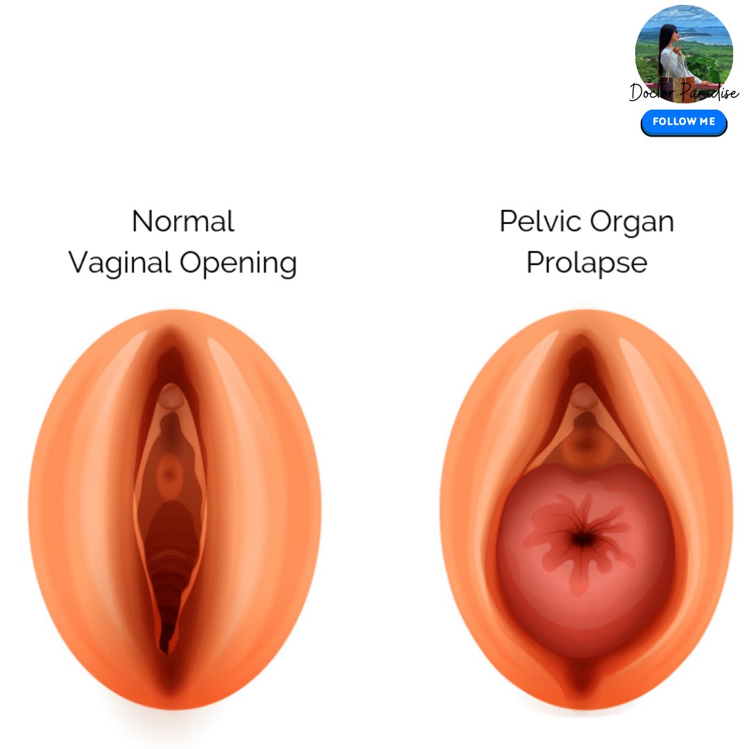 Escape2SEA's tweet photo. Ever felt heaviness or pressure down there? — It could be Pelvic Organ Prolapse (POP).

Read The Thread👇 https://t.co/onvb3gS1hg