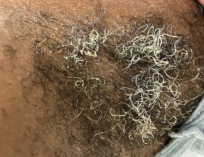 ItsMrHealth's tweet image. Ugonjwa huu kitaalamu hujulikana kama (Trichomycosis axillaris) Husababishwa na maambukizi ya bakteria,(Corynebacterium).

Bakteria hao hukua kwenye maeneo ya nywele za sehemu za kwapa...

Hali hii mara nyingi husababisha nywele kuwa na dots nyeupe au rangi ya kijani kibichi na…