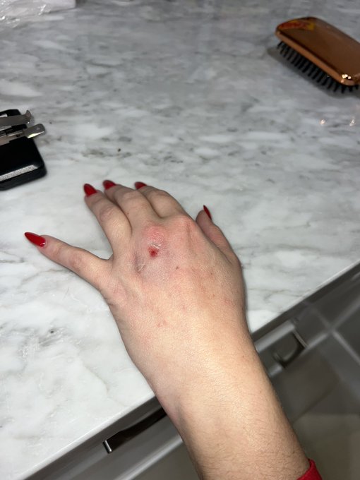 2 pic. I might have broken my wrist.. I got hit with a 50 miles per hour ball https://t.co/IXiNqy0Nm