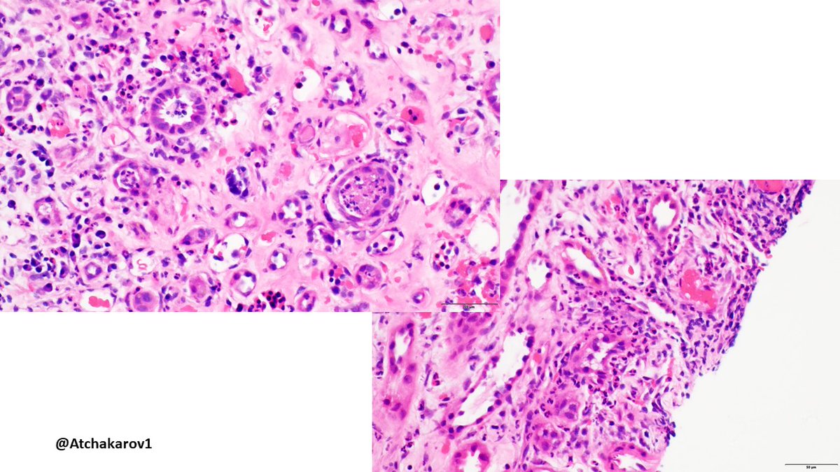 ATchakarov1's tweet image. 👀 look at what&apos;s in the background of this case of pyelonephritis, not used to seeing those cells in a kidney biopsy. #renalpath #nephropath #PathX #PathTwitter