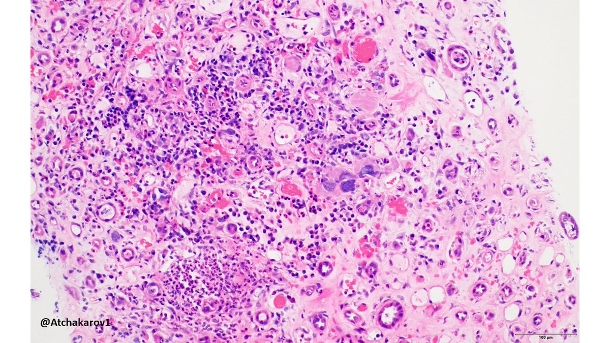 ATchakarov1's tweet image. 👀 look at what&apos;s in the background of this case of pyelonephritis, not used to seeing those cells in a kidney biopsy. #renalpath #nephropath #PathX #PathTwitter