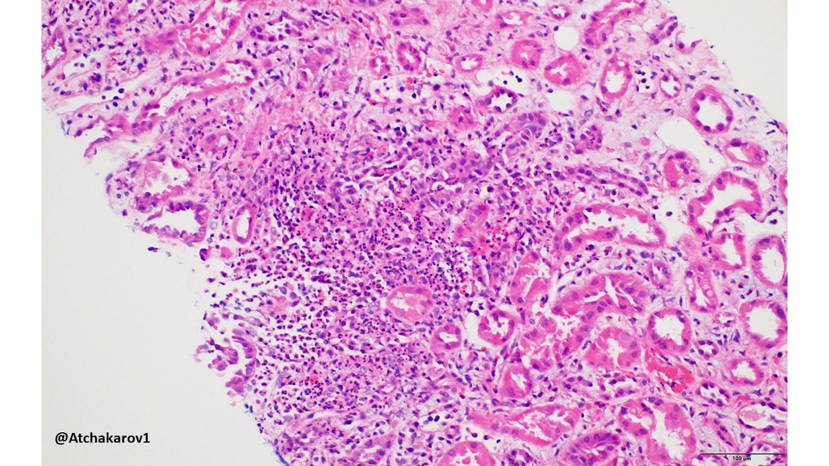 ATchakarov1's tweet image. 👀 look at what&apos;s in the background of this case of pyelonephritis, not used to seeing those cells in a kidney biopsy. #renalpath #nephropath #PathX #PathTwitter