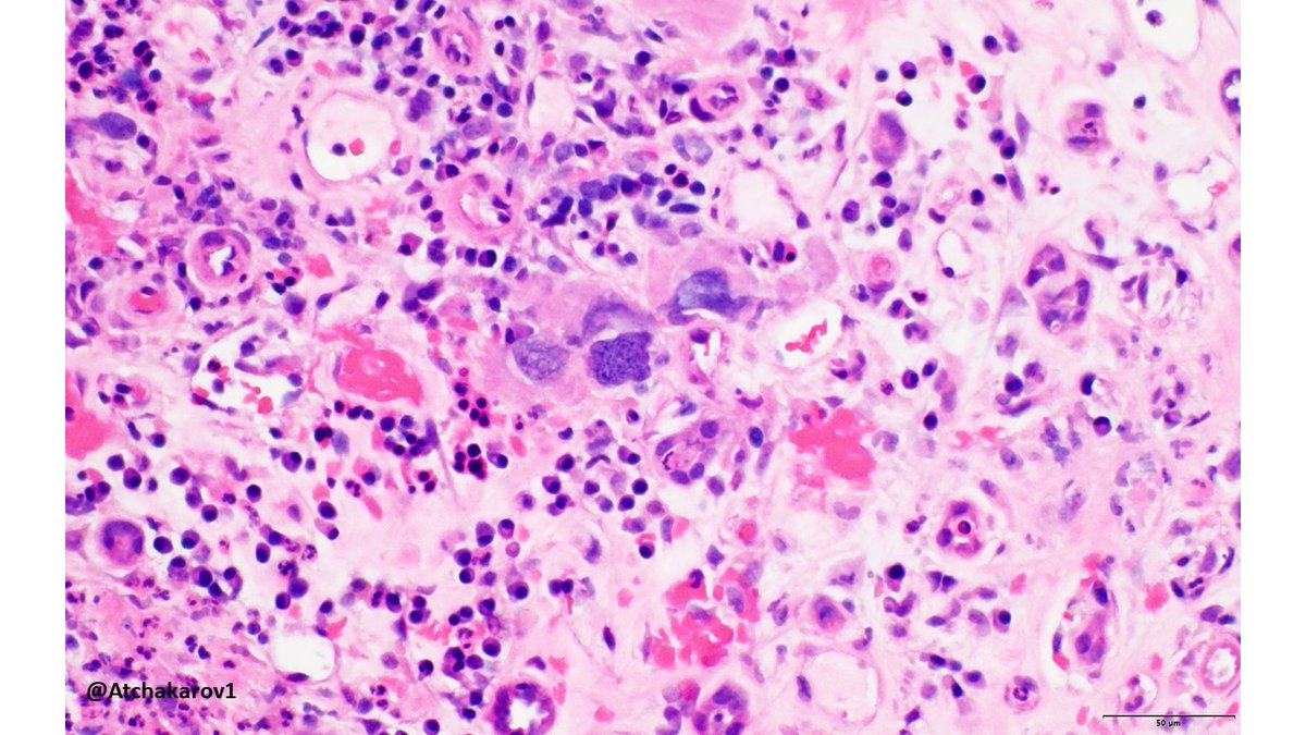 ATchakarov1's tweet image. 👀 look at what&apos;s in the background of this case of pyelonephritis, not used to seeing those cells in a kidney biopsy. #renalpath #nephropath #PathX #PathTwitter