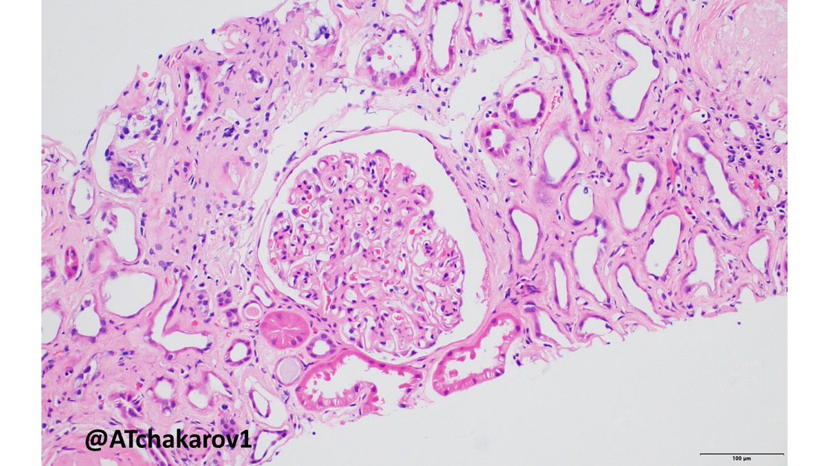 ATchakarov1's tweet image. Usually when I get a renal biopsy for proteinuria in a diabetic patient, it ends up being diabetic nephropathy...but sometimes there&apos;s something else going on. 👀🔬 #RenalPath #Nephropath #Nephrology #PathX #PathTwitter