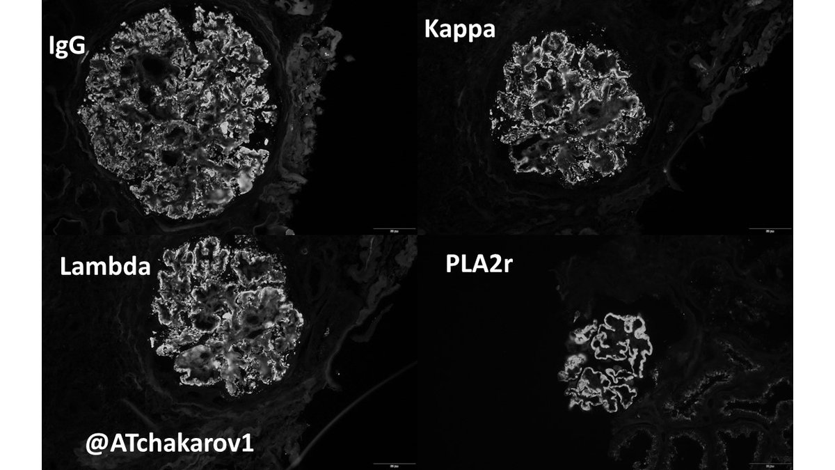 ATchakarov1's tweet image. Usually when I get a renal biopsy for proteinuria in a diabetic patient, it ends up being diabetic nephropathy...but sometimes there&apos;s something else going on. 👀🔬 #RenalPath #Nephropath #Nephrology #PathX #PathTwitter