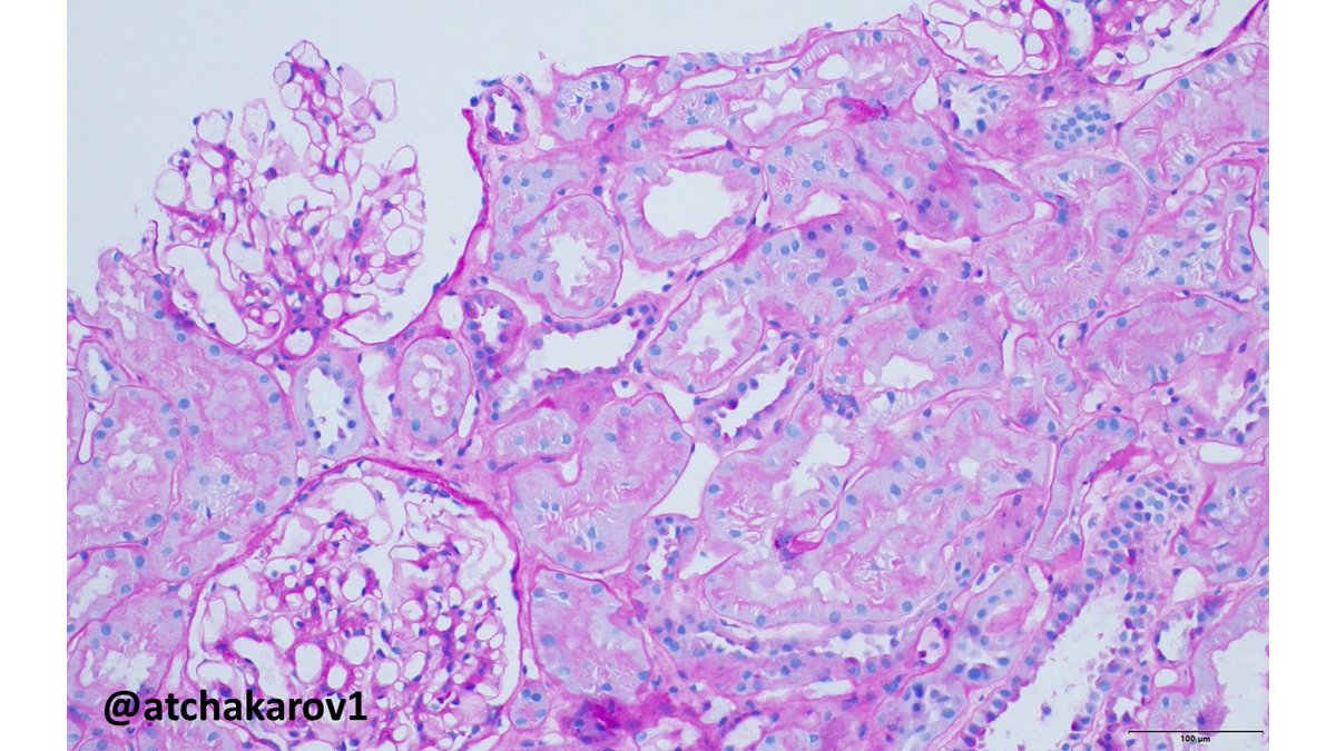 ATchakarov1's tweet image. Transplant biopsy without viral cytopathic effect, but with granular tubular basement membrane deposits, prompting SV40T staining and revealing BK nephropathy (pvl1). #renalpath #nephropath #transplantpath #pathX #PathTwitter