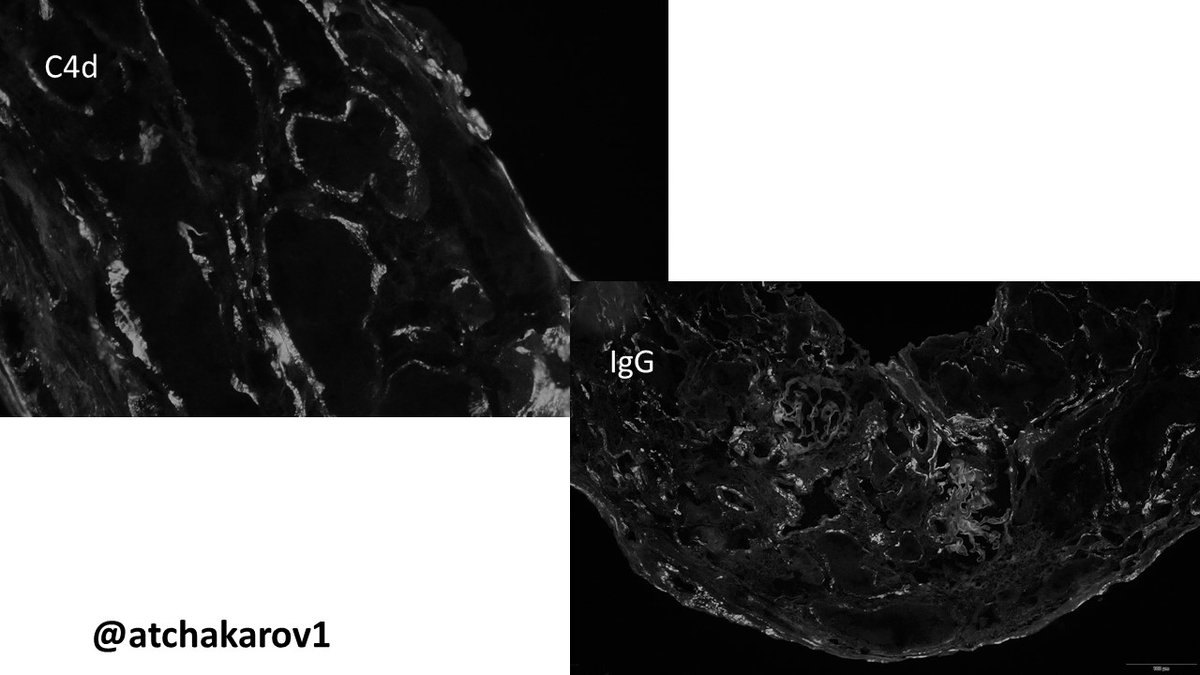ATchakarov1's tweet image. Transplant biopsy without viral cytopathic effect, but with granular tubular basement membrane deposits, prompting SV40T staining and revealing BK nephropathy (pvl1). #renalpath #nephropath #transplantpath #pathX #PathTwitter