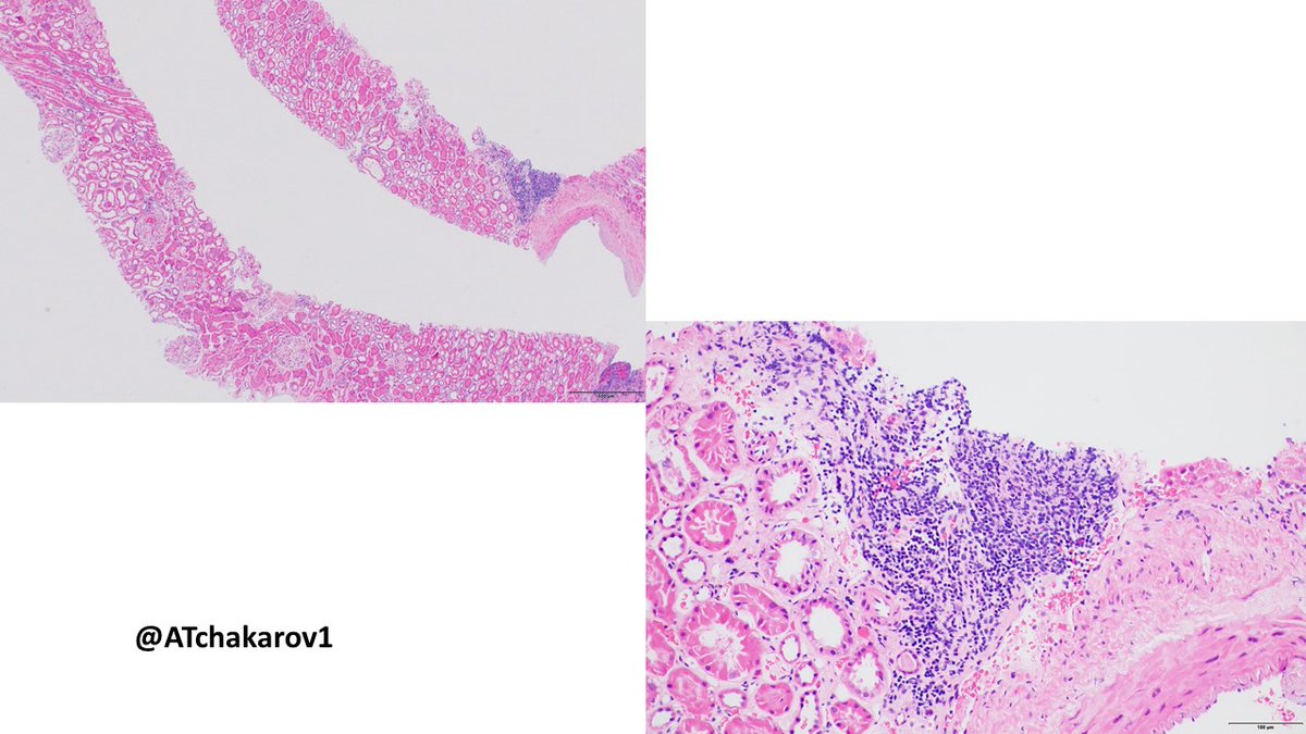 ATchakarov1's tweet image. Membranous glomerulopathy and something else? 🤔🔬#RenalPath #Nephropath #PathX #PathTwitter
