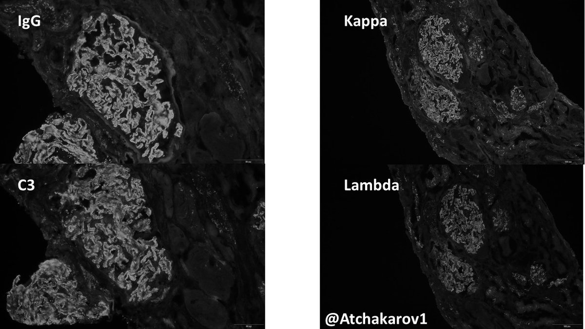 ATchakarov1's tweet image. Membranous glomerulopathy and something else? 🤔🔬#RenalPath #Nephropath #PathX #PathTwitter
