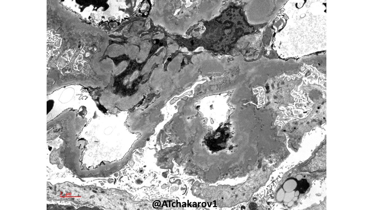ATchakarov1's tweet image. Membranous glomerulopathy and something else? 🤔🔬#RenalPath #Nephropath #PathX #PathTwitter