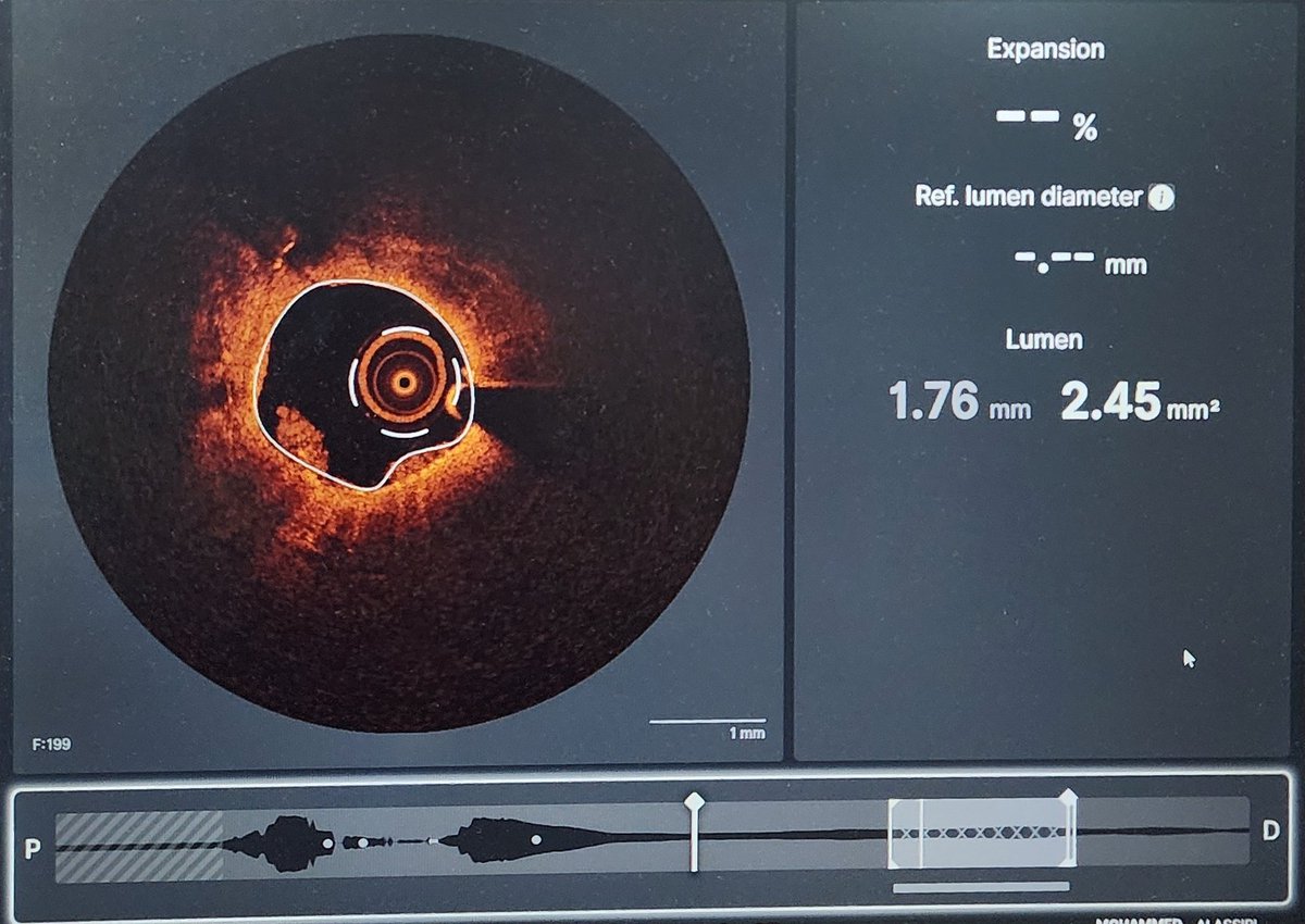 Hussain Alzayer | حسين الزاير (@zayer_h) on Twitter photo VF arrest followed by ROSC. LBBB on ECG. Shock. Severe LV dysfunction.
Urgent LHC showed hazy ISR in the proximal LAD.
#OCT below.
What would you do?
<a href="/mirvatalasnag/">MIЯVΛƬ #IC</a> <a href="/MogneeA/">Mognee Alameer</a> <a href="/DrNataliaP/">Natalia Pinilla</a> <a href="/ziadalinyc/">Ziad Ali</a> <a href="/mmamas1973/">Mamas A. Mamas</a> <a href="/DrAlshatti/">Ahmad Alshatti</a> <a href="/jedicath/">jedicath աǟզǟʀ.ǟɦʍɛɖ</a> <a href="/A_Esmaiel85/">Abdullah Esmaiel</a> VF arrest followed by ROSC. LBBB on ECG. Shock. Severe LV dysfunction.
Urgent LHC showed hazy ISR in the proximal LAD.
#OCT below.
What would you do?
<a href="/mirvatalasnag/">MIЯVΛƬ #IC</a> <a href="/MogneeA/">Mognee Alameer</a> <a href="/DrNataliaP/">Natalia Pinilla</a> <a href="/ziadalinyc/">Ziad Ali</a> <a href="/mmamas1973/">Mamas A. Mamas</a> <a href="/DrAlshatti/">Ahmad Alshatti</a> <a href="/jedicath/">jedicath աǟզǟʀ.ǟɦʍɛɖ</a> <a href="/A_Esmaiel85/">Abdullah Esmaiel</a>