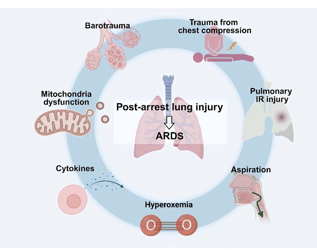 〰️🫁Lesión pulmonar secundaria a paro cardíaco 💥🫀
📌Lo lesión pulmonar post-arresto (PALI), que contribuye significativamente a los malos resultados. PALI surge de una compleja interacción de mecanismos fisiopatológicos,incluyendo trauma por compresiones torácicas, lesión 👇🏻
