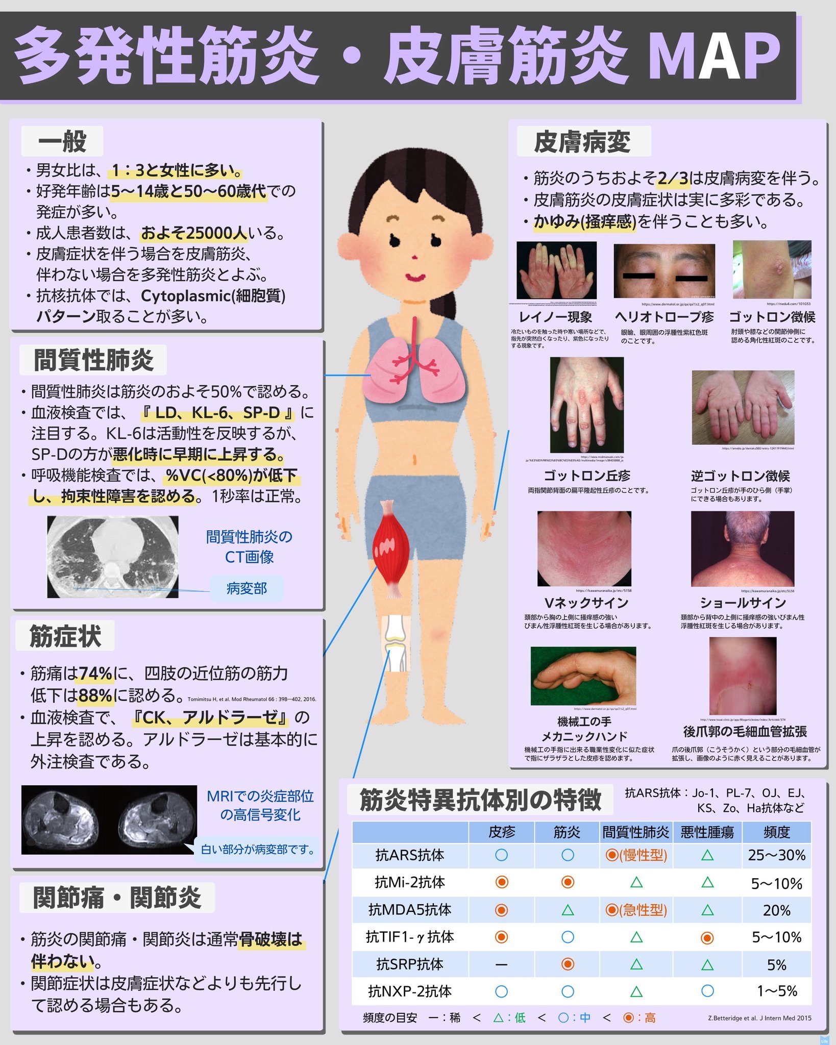 多発 性 筋炎