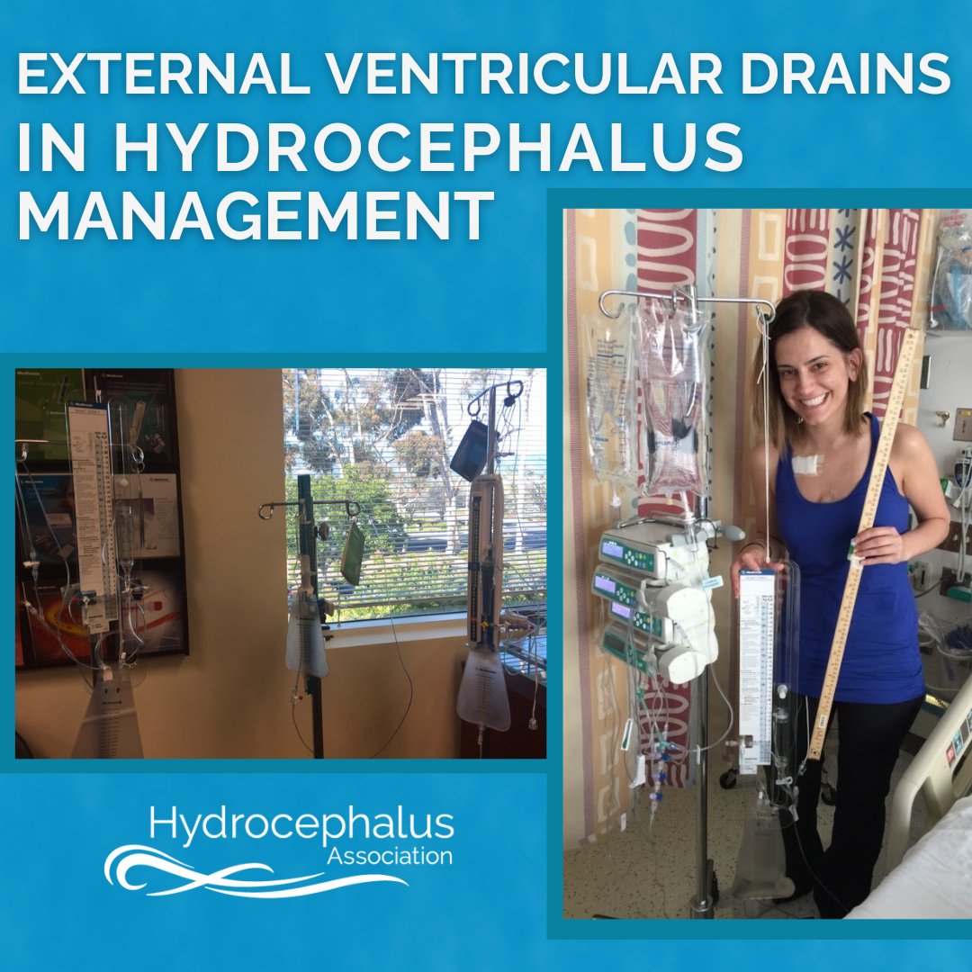 HydroAssoc's tweet photo. External Ventricular Drains (EVDs) help manage #hydrocephalus by reducing brain pressure. Learn when EVDs are used, how they’re placed, monitored, and removed, and what patients &amp; families can expect: https://t.co/GYaISzl1vX
#EVD #ExternalVentricularDrain #CSF #ShuntMalfunction https://t.co/dqelUc0FkV