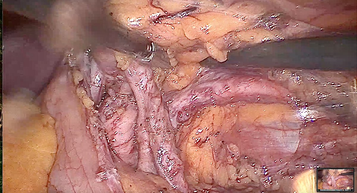 gutierrez_uro's tweet photo. BEFORE // AFTER

@UroBierzo https://t.co/1mfKKu4ZQs