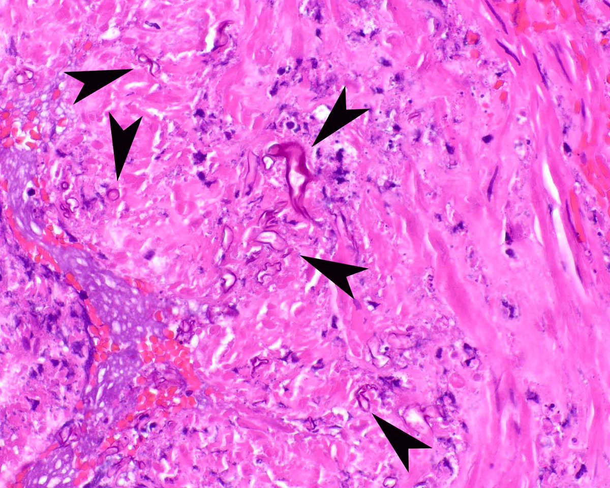 Beware angio-invasive Zygomycetes - this is probably mucormycosis and required extensive soft tissue debridement.  The dreaded fungi are indicated (arrows).