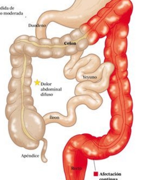 belyreb's tweet photo. Es una enfermedad crónica de la mucosa del colon. Se caracteriza por episodios de recaída, remisión y exacerbación. Tiene un patrón continuo desde el recto que puede afectar todo el colon. Incidencia 20-40 años Hombres y mujeres.🚻 https://t.co/hFHijL8euA