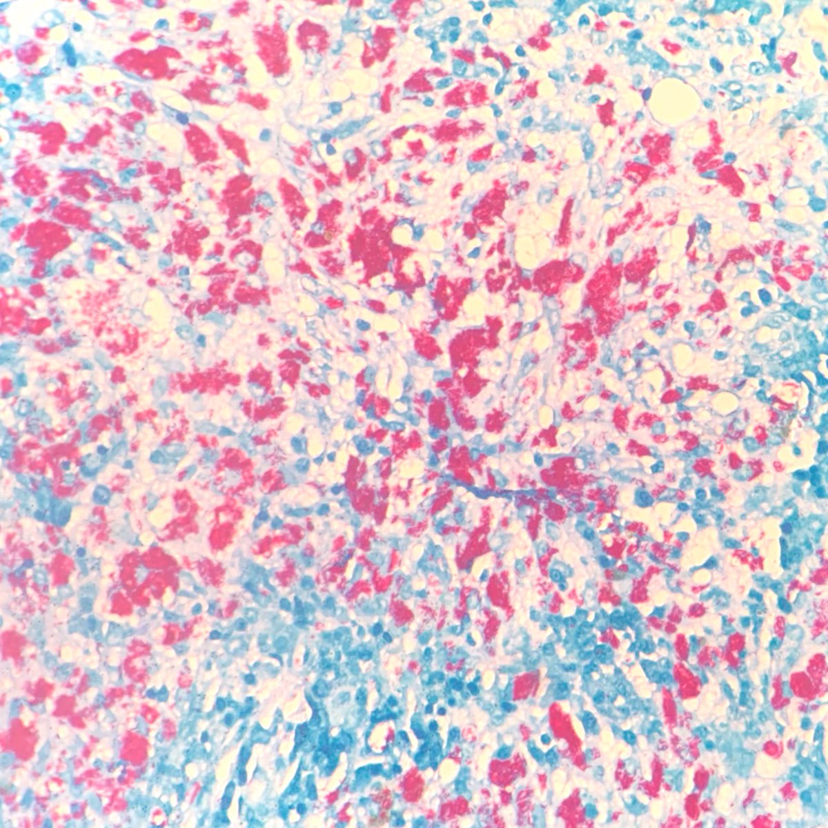 A 35 year old PLHA, bone marrow for evaluation.

#pathX #ThrowbackThursday #pathology