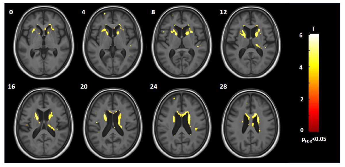 GeroScienceAGE's tweet photo. 📢New Recommended Reading📖
Aβ42 biomarker linked to insula, striatum, thalamus and claustrum in dementia with Lewy bodies by Vincent Gabriel & Frédéric Blanc (@BlancFrdric7) et al.
https://t.co/oM9yIC3dZm
#dementia #LewyBodies #aβ42 #amyloid #voxelbasedmorphometry #cerebrospinalfluid