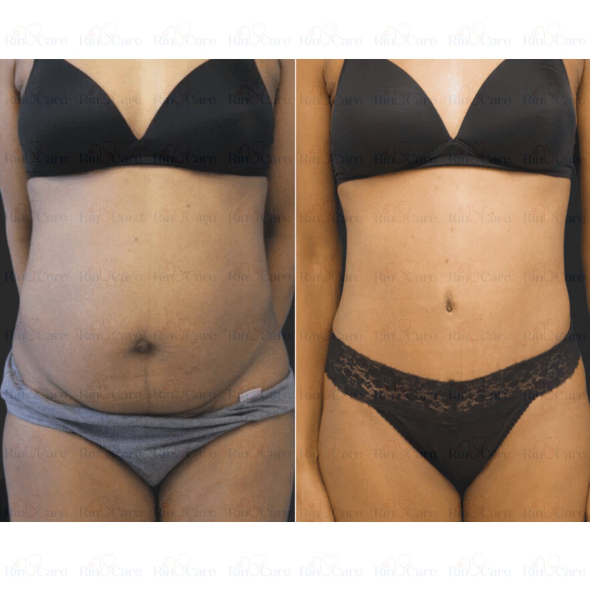 rinucare's tweet photo. #TummyTuck #TummyTuckTurkey #Abdominoplasty #BodyTransformation #FlatStomachJourney #MommyMakeover #MedicalTourism #PlasticSurgeryTurkey #UKPatientsInTurkey #FromEnglandToTurkey #TummyTuckFromUK #UKToTurkeySurgery #TurkeySurgeryExperience #TurkeySurgeryTrip #BeforeAndAfter https://t.co/JzQ6PFGIqs