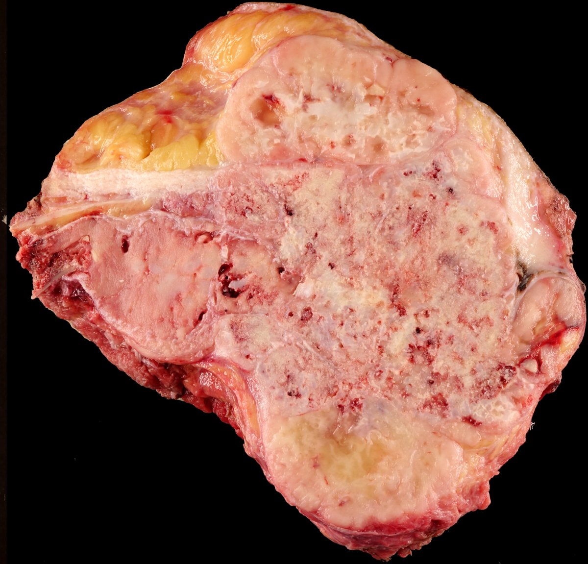 Elizabeth Montgomery, MD (@lizmontgomerymd) on Twitter photo This mesenchymal chondrosarcoma can be diagnosed on H&E because it displays the round cell component and mature-appearing cartilage, but it can be tough on needle biopsies and NKX2.2 is often reactive!
Mod Pathol. 2016 Apr;29(4):370-80. PMID: 26847175. <a href="/ModernPathology/">Modern Pathology</a> This mesenchymal chondrosarcoma can be diagnosed on H&E because it displays the round cell component and mature-appearing cartilage, but it can be tough on needle biopsies and NKX2.2 is often reactive!
Mod Pathol. 2016 Apr;29(4):370-80. PMID: 26847175. <a href="/ModernPathology/">Modern Pathology</a>