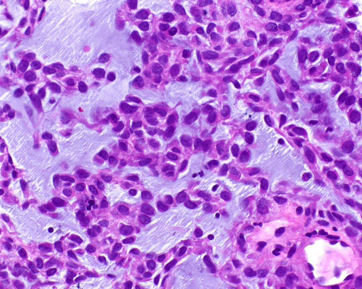 Extraskeletal myxoid chondrosarcoma has a characteristic appearance, but Modern Pathology offers help for those who need it - CHRNA6 RNA In Situ Hybridization . See Mod Pathol. 2024 May;37(5):100464. PMID: 38447752 for details.