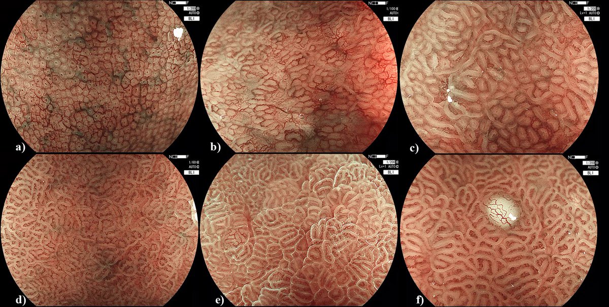 Robert Bechara (@robertbechara) on Twitter photo Thrilled to share our latest paper on Autoimmune Atrophic Gastritis (AIG)! Honored to have collaborated with two incredible colleagues—Dr. Kareem Khalaf and Dr. <a href="/YusukeFujiyoshi/">Yusuke Fujiyoshi, MD</a>
Check out the key endoscopic and clinical characteristics of AIG here:➡️ thieme-connect.com/products/ejour… Thrilled to share our latest paper on Autoimmune Atrophic Gastritis (AIG)! Honored to have collaborated with two incredible colleagues—Dr. Kareem Khalaf and Dr. <a href="/YusukeFujiyoshi/">Yusuke Fujiyoshi, MD</a>
Check out the key endoscopic and clinical characteristics of AIG here:➡️ thieme-connect.com/products/ejour…