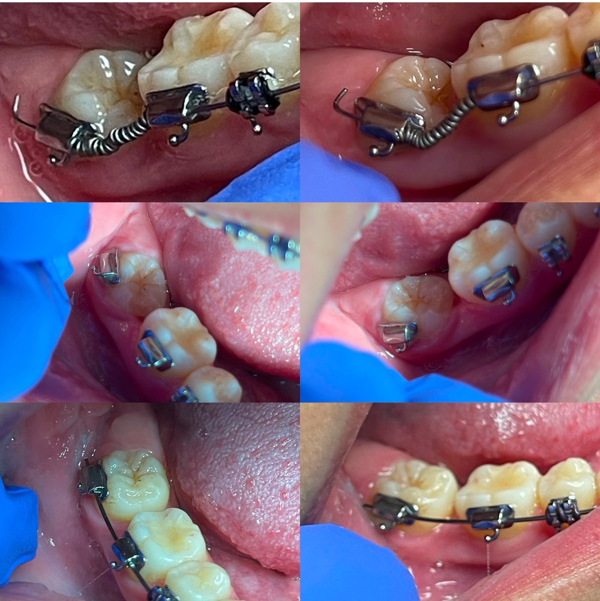 Textbook_Ortho's tweet photo. How to correct an impacted second molar? #braces #impactedteeth https://t.co/i5G7LLMjVB