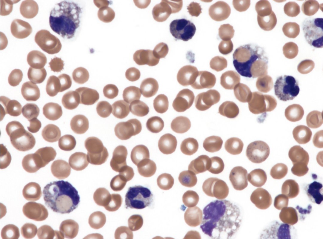 salvadorpayan's tweet image. Pregunta de #Eritropatología en #MIR2025: hemoglobinuria paroxística fría o a frigore,rareza en adultos.Anemia hemolítica intravascular (Hb libre en plasma) episódica,desencadenada por frío, sin aglutinación en el frotis, típica eritrofagocitosis,Coombs + para complemento, anti-P