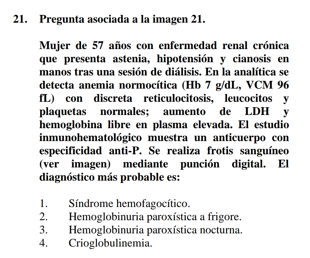 salvadorpayan's tweet image. Pregunta de #Eritropatología en #MIR2025: hemoglobinuria paroxística fría o a frigore,rareza en adultos.Anemia hemolítica intravascular (Hb libre en plasma) episódica,desencadenada por frío, sin aglutinación en el frotis, típica eritrofagocitosis,Coombs + para complemento, anti-P