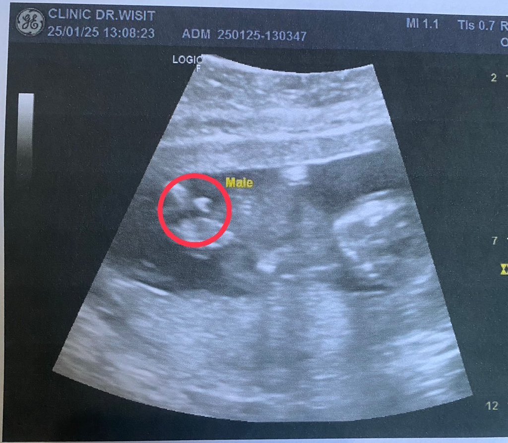 Au_I's tweet photo. ออกมาจะซนมั้ยน้อ 😅😅 อยู่ในท้องยังหมุน ดิ้นขนาดนี้ #ท้อง2 #น้องชาย #14weekspregnant https://t.co/xkzYPWc9kY