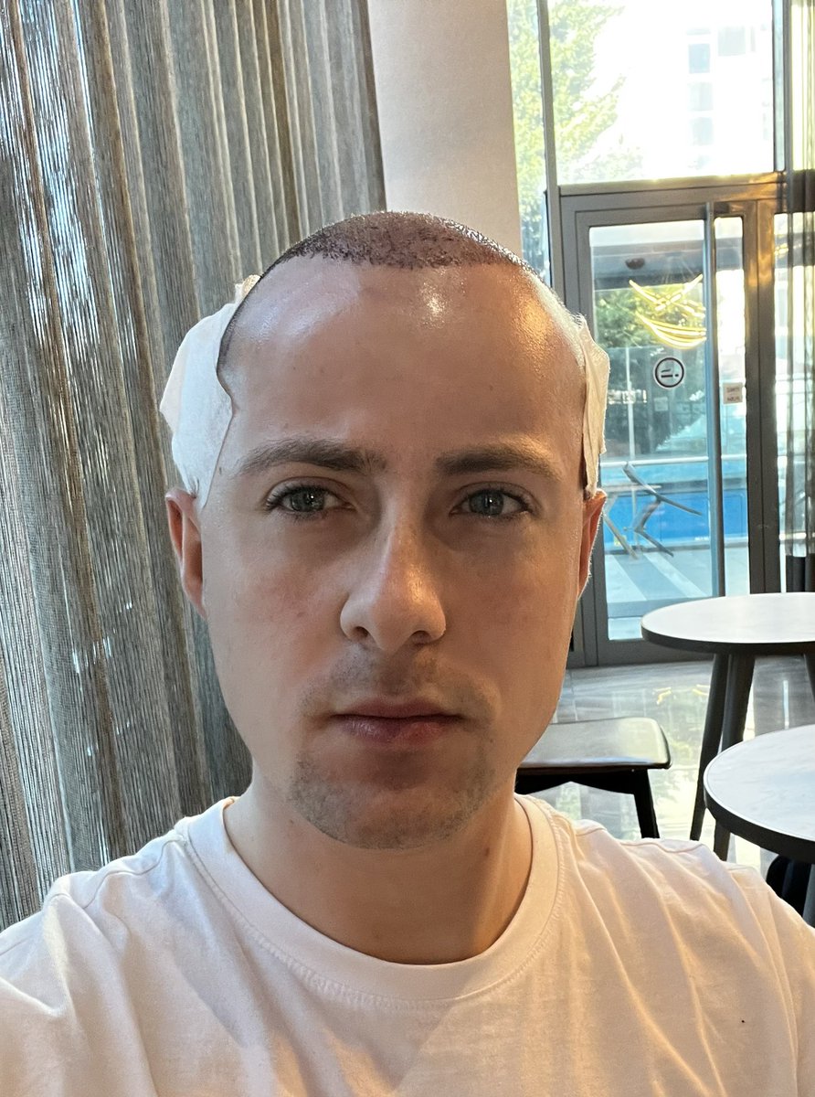 Lordmiles's tweet photo. After the hair transplant, my head may be inflamed, but atleast I don’t have a Somalian head. https://t.co/CY2QIExYMC