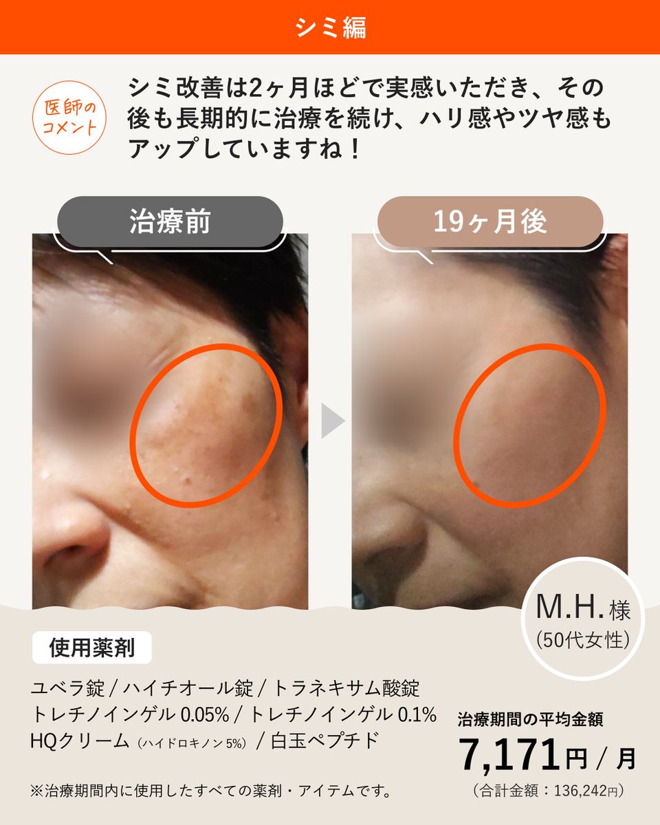 シミにお悩みだったM.H.様（50代女性）の ビフォーアフターです✨ シミ