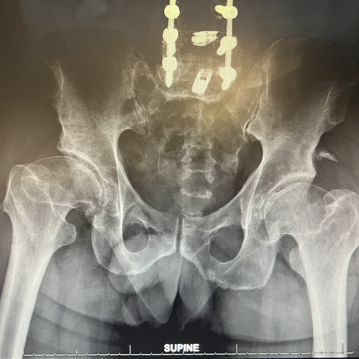 The hip-spine axis was strong in this one. 
#orthopedics #perthes #lumbar-spine