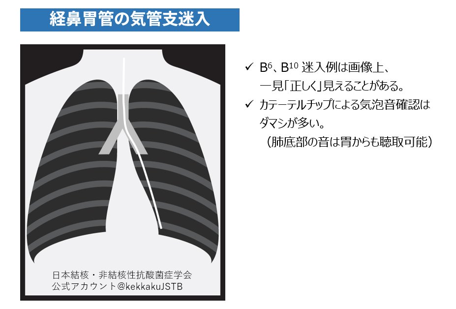 患者の咳嗽反射がなく、B6やB10に迷入すると、あたかも適切に留置されているような画像が返ってくることがあるので、この状態で注入を開始しないよう注意してください。カテーテルチップによる音は、たとえ肺底部でも胃近傍から聴こえることがあります。