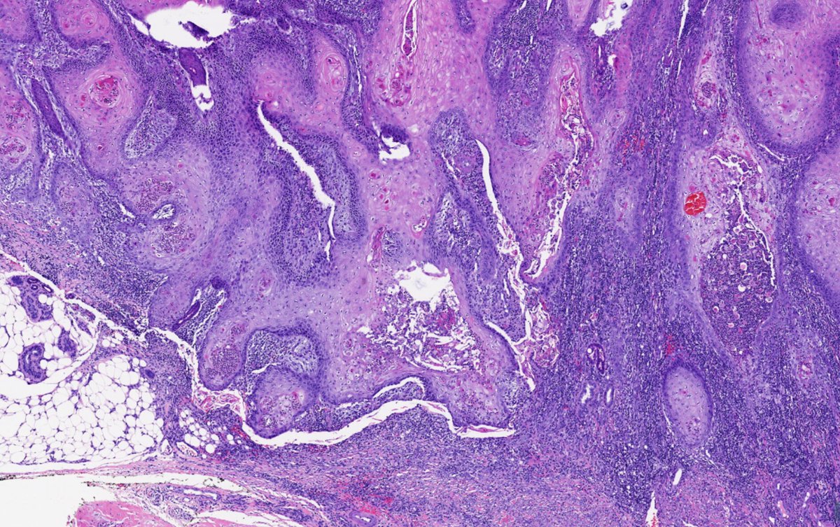 Henry YANG (@henryy_md) on Twitter photo Verrucous squamous Lesion.
77 year old. hand. duration 10 years
#dermapth
Without <a href="/RACARR51/">Richard Carr</a> cocktail stains (P53, P16, Ki67), what would you call this lesion? I will not call it verrucous carcinoma for sure...<a href="/mccalmo/">Tim McCalmont</a> <a href="/david_terrano/">David Terrano</a> <a href="/tonitatirado/">Mariantonieta Tirado</a> Verrucous squamous Lesion.
77 year old. hand. duration 10 years
#dermapth
Without <a href="/RACARR51/">Richard Carr</a> cocktail stains (P53, P16, Ki67), what would you call this lesion? I will not call it verrucous carcinoma for sure...<a href="/mccalmo/">Tim McCalmont</a> <a href="/david_terrano/">David Terrano</a> <a href="/tonitatirado/">Mariantonieta Tirado</a>