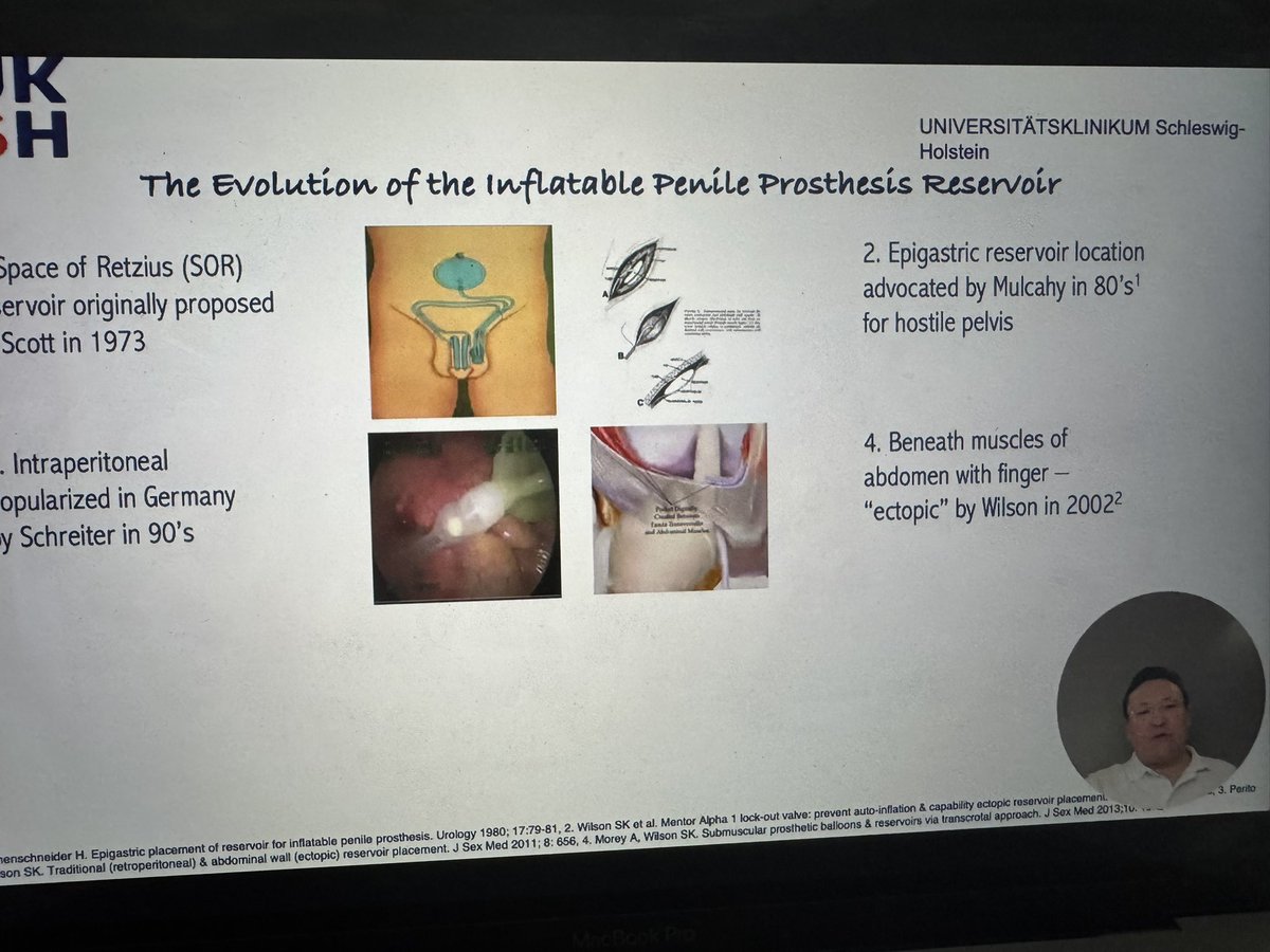 Elia Abou Chawareb (@eliachawareb) on Twitter photo Another very interesting section on Surgical Treatments for ED moderated by <a href="/faysal_a_yafi/">Faysal A. Yafi, MD FRCSC</a>
Speakers: <a href="/DrEricChung/">Eric Chung</a> <a href="/NunoTomada/">Nuno Tomada</a>, Dr. Carvajal, Dr. Gross, Dr. Shaeer, Dr. Karpman, <a href="/dr_romero_otero/">Javier Romero Otero</a>, Dr. Park, <a href="/CarloBettocchi/">Prof. Carlo Bettocchi</a>, Dr. Ralph, <a href="/uro11/">jose ramon mata manz</a> <a href="/OsmonovDr/">Prof. Dr. Daniar Osmonov, FECSM</a>, Dr. Egydio, <a href="/SexHealthMD/">Tobias S. Köhler, MD, MPH</a> Another very interesting section on Surgical Treatments for ED moderated by <a href="/faysal_a_yafi/">Faysal A. Yafi, MD FRCSC</a>
Speakers: <a href="/DrEricChung/">Eric Chung</a> <a href="/NunoTomada/">Nuno Tomada</a>, Dr. Carvajal, Dr. Gross, Dr. Shaeer, Dr. Karpman, <a href="/dr_romero_otero/">Javier Romero Otero</a>, Dr. Park, <a href="/CarloBettocchi/">Prof. Carlo Bettocchi</a>, Dr. Ralph, <a href="/uro11/">jose ramon mata manz</a> <a href="/OsmonovDr/">Prof. Dr. Daniar Osmonov, FECSM</a>, Dr. Egydio, <a href="/SexHealthMD/">Tobias S. Köhler, MD, MPH</a>