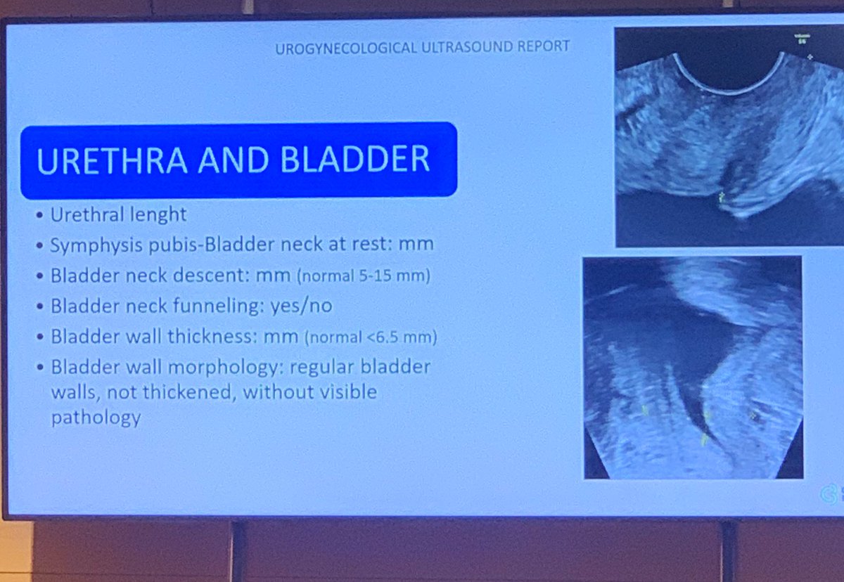 Luisana_Castil's tweet photo. 🌟Evaluación avanzada de los trastornos del suelo pélvico: urodinamia y ecografía 
EUGA Course/IUGA. Con @elicorrales 

Gracias Dra Cristina Ross,Dr Jordi Cassado, Dra Sonia Anglès @TdudleyR @angelarantell @iugaoffice. Excelente curso📣
#UroFUNC #aulaclinic #incontinencia #suelopélvico #ecografía